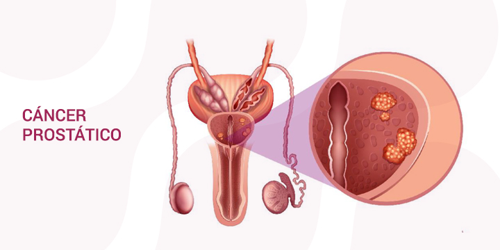 Cáncer Prostático