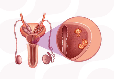 Cáncer Prostático